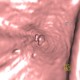 Adenocarcinoma of gallbladder, fistula to colon: CT - Computed tomography